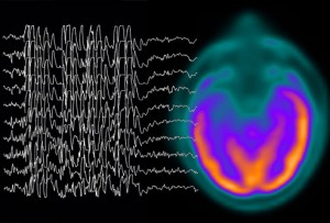 Brain Injury of All Sizes can Trigger Grand Mal Seizures erratic brain signals due to injury