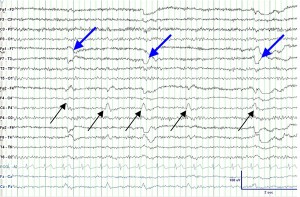 Possibilities Of SSI Disability Benefits For Your Grand Mal Seizure