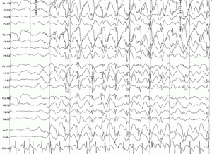 Absence Seizure A Few Dietary Precautions May Prevent Serious Damages EEG
