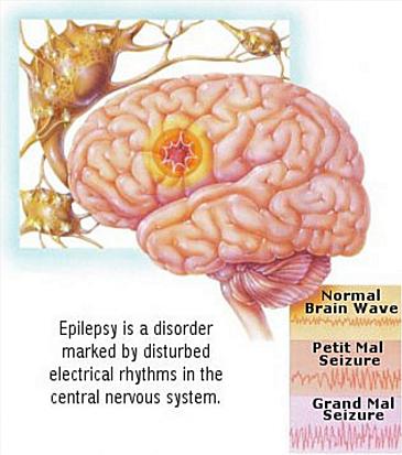 Different Brain Waves And Seizures